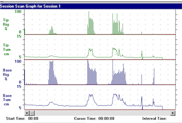 리지스캔 발기부전검사