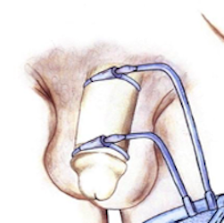 리지스캔 발기부전검사